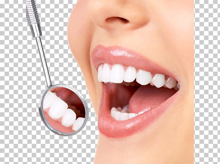 Dentistry Tooth Whitening Human Tooth Crown PNG, Clipart, Bridge, Chin, Cosmetic Dentistry, Crown, Dental Implant Free PNG Download