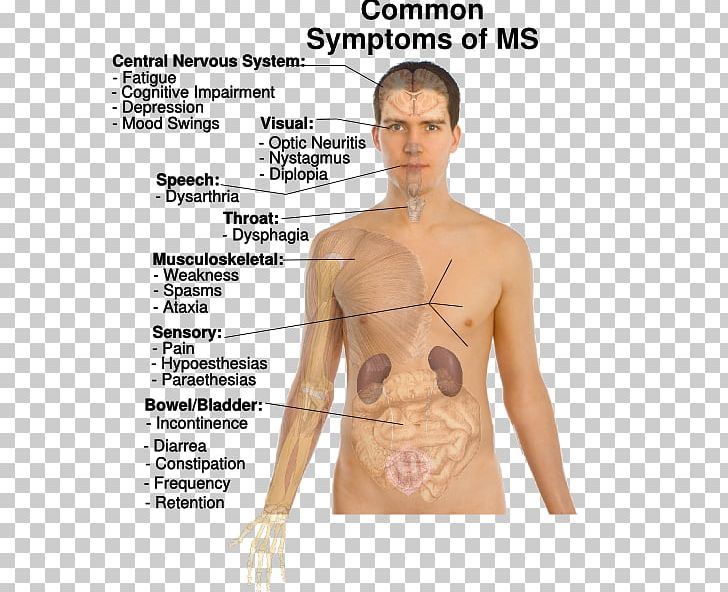 Multiple Sclerosis Signs And Symptoms Multiple Sclerosis Signs And Symptoms Medical Sign Disease PNG, Clipart, Abdomen, Ache, Active Undergarment, Arm, Back Free PNG Download