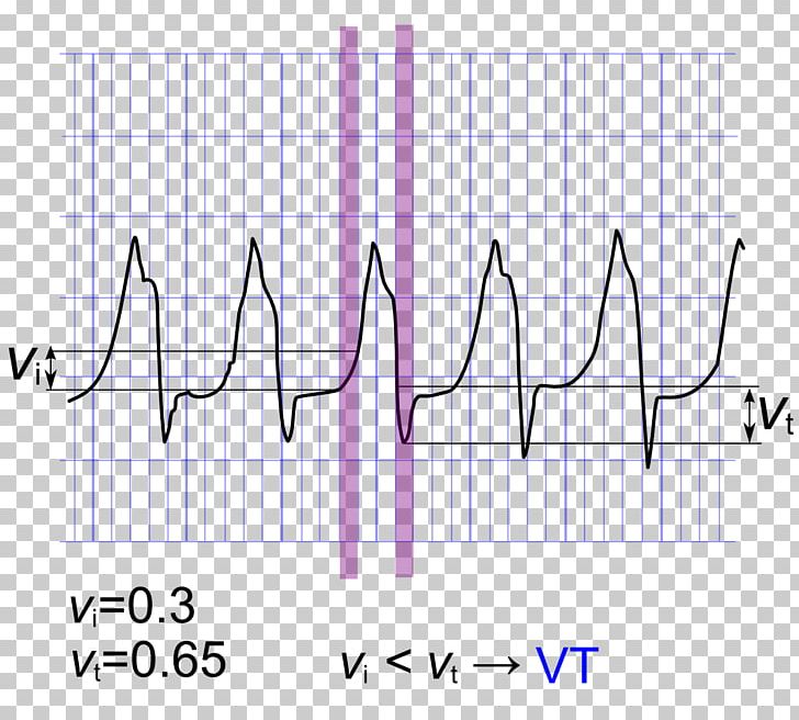 QRS Complex Ventricular Tachycardia Algorithm Bundle Branch Block Electrocardiography PNG, Clipart, Algorism, Algorithm, Angle, Area, Blue Free PNG Download