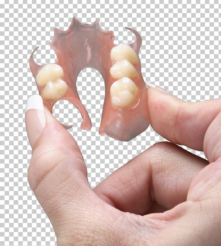 Dentures Dental Laboratory Dentistry Removable Partial Denture PNG, Clipart, Ceramic, Dental Braces, Dental Implant, Dental Laboratory, Dental Restoration Free PNG Download