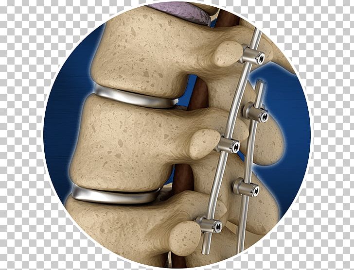 Vertebral Fixation Vertebral Column Stock Photography PNG, Clipart, Biomedical Engineering, Drawing, Engineering, Failed, Others Free PNG Download