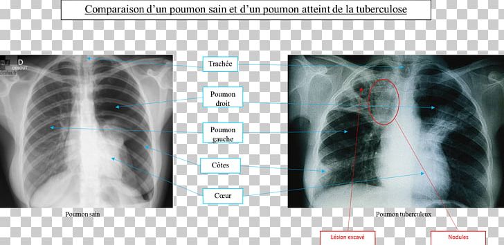Tuberculosis Radiology Lung Medicine Infectious Disease PNG, Clipart, Disease, Fumer, Infection, Infectious Disease, Jaw Free PNG Download