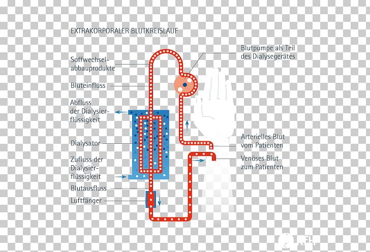 Dialysis Dialysator Blood Medicine Reverse Osmosis PNG, Clipart, Angle, Area, Blood, Brand, Convection Free PNG Download