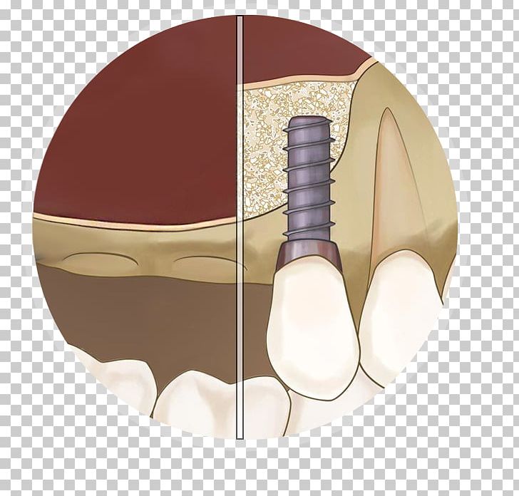 Sinus Lift Maxillary Sinus Dental Implant PNG, Clipart, Anatomy, Bone, Com, Dental Implant, Dentistry Free PNG Download