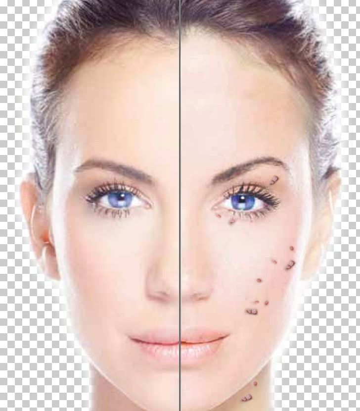 Laser Collagen Induction Therapy Skin Exfoliation Chemical Peel PNG, Clipart, Acne, Beauty, Cheek, Chin, Closeup Free PNG Download