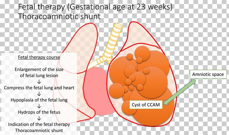 Congenital Pulmonary Airway Malformation Shunt Fetus Lung Cyst PNG, Clipart, Area, Birth Defect, Blood, Cyst, Diagram Free PNG Download