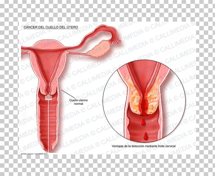 Cervical Cancer Uterine Cancer Cervix Uterus PNG, Clipart, Breast Cancer, Cancer, Carcinoma, Cervical Cancer, Cervix Free PNG Download