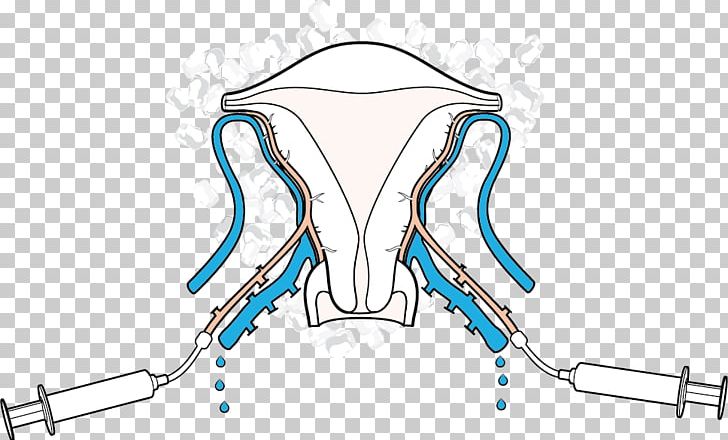 Uterus Transplantation Female Infertility In Vitro Fertilisation PNG, Clipart, Angle, Area, Blood Vessel, Blue, Cytoplasmic Male Sterility Free PNG Download