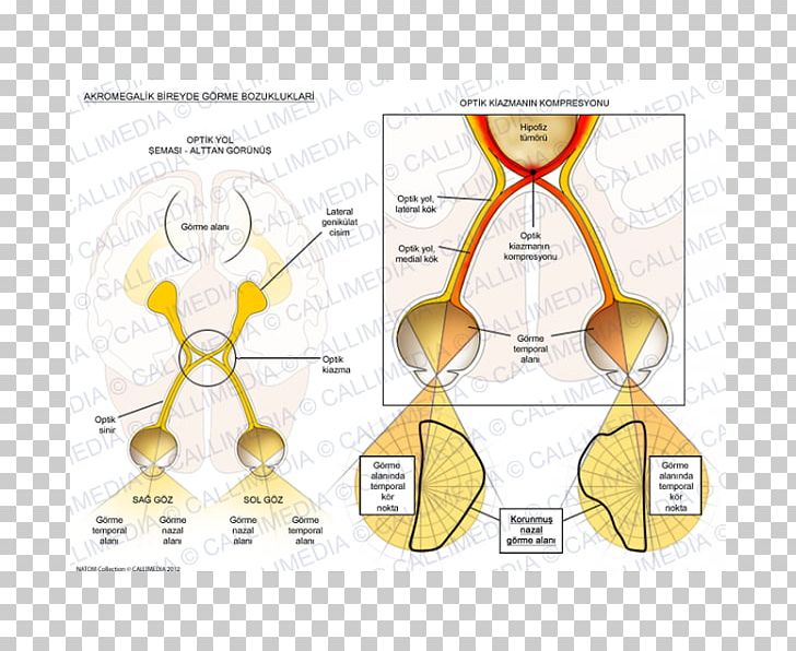 Acromegaly Paper Organism Nose Human Behavior PNG, Clipart, Acromegaly, Angle, Area, Behavior, Body Free PNG Download