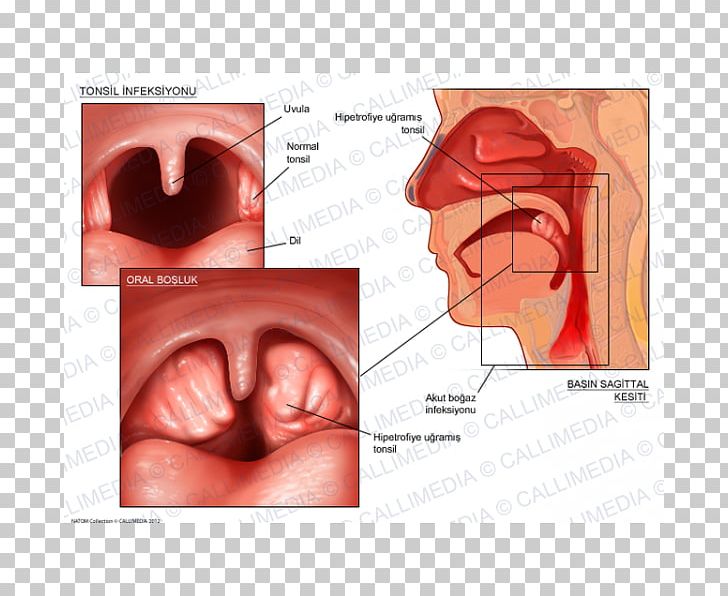 Tonsillitis Pharyngitis Otorhinolaryngology Adenoid PNG, Clipart, Adenoid, Anatomy, Cheek, Chin, Ear Free PNG Download