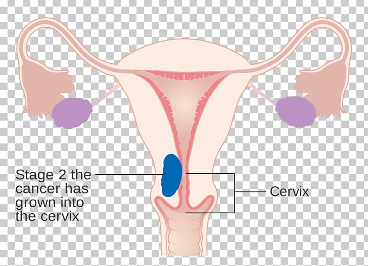 Endometrial Cancer Uterus Cancer Staging Ovarian Cancer PNG, Clipart, Abdomen, Angle, Arm, Cancer, Cancer Staging Free PNG Download