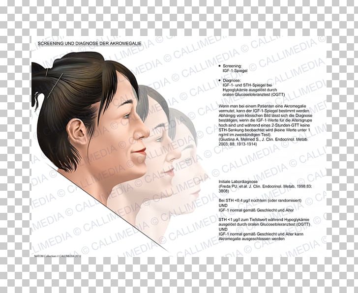 Acromegaly Diagnose Symptom Medical Diagnosis PNG, Clipart, Acromegaly, Cheek, Chin, Diabetes Mellitus, Diagnose Free PNG Download