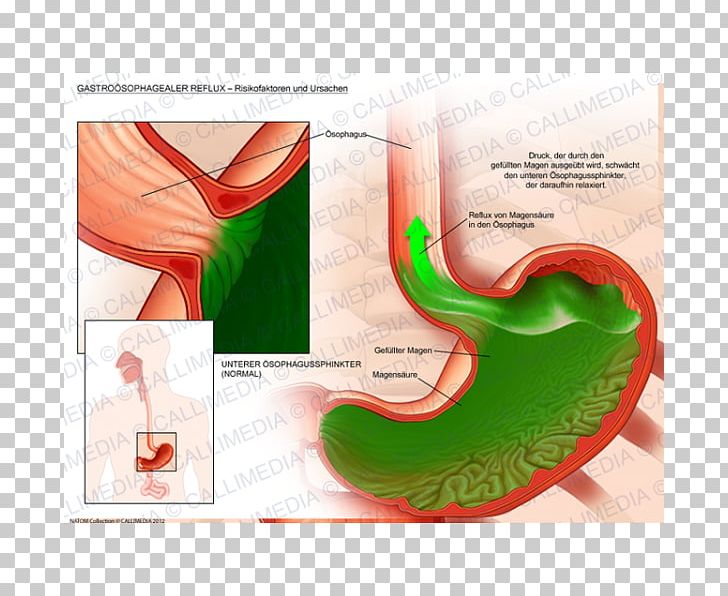 Gastroesophageal Reflux Disease Gastroenterology Gastroenteritis Pathology PNG, Clipart, Esophagus, Gastroenteritis, Gastroenterology, Gastroesophageal Reflux Disease, Homo Sapiens Free PNG Download