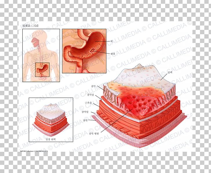 Peptic Ulcer Disease Skin Ulcer Erosion Mucous Membrane Mouth Ulcer PNG, Clipart, Balanitis, Erosion, Gastric Mucosa, Gastritis, Gastroenterology Free PNG Download