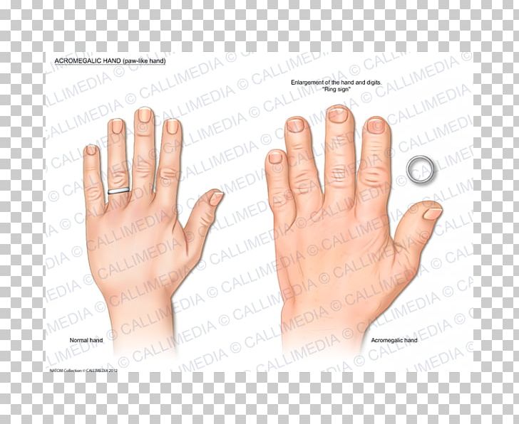 Thumb Acromegaly Hand Endocrinology Growth Hormone PNG, Clipart, Acromegaly, Arm, Digit, Disease, Endocrinology Free PNG Download