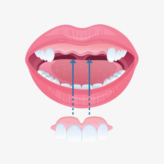 Hand-painted Front Teeth Braces PNG, Clipart, Arrow, Braces Clipart, Front Clipart, Hand, Hand Painted Free PNG Download