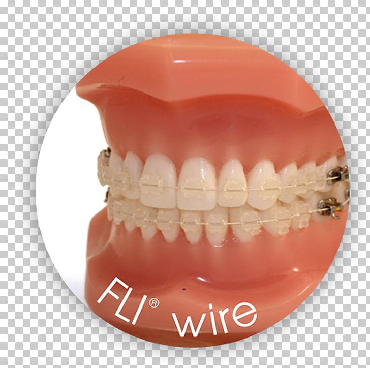 Nickel Titanium Orthodontic Archwire PNG, Clipart, Alloy, Copper, Copper Conductor, Cupronickel, Dental Braces Free PNG Download