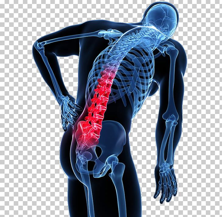 Low Back Pain Human Back Vertebral Column PNG, Clipart, Arthritis, Back Pain, Chiropractic, Disease, Electric Blue Free PNG Download