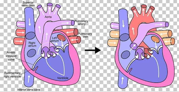 Fontan Procedure Heart Surgery Tricuspid Atresia Pulmonary Artery PNG, Clipart, Atresia, Atrium, Congenital Heart Defect, Diagram, Double Inlet Left Ventricle Free PNG Download