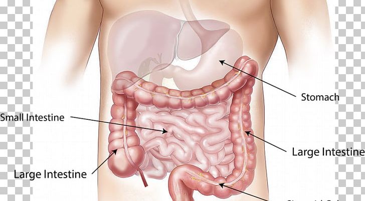 Colorectal Cancer Screening Large Intestine Colonoscopy PNG, Clipart, Abdomen, Bowel Obstruction, Cancer, Causes Of Cancer, Cecum Free PNG Download