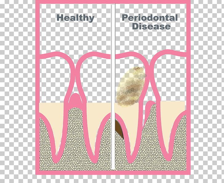 Periodontology Periodontal Disease Periodontium Gums Tooth PNG, Clipart, Area, Brand, Disease, Flap, Glenview Free PNG Download
