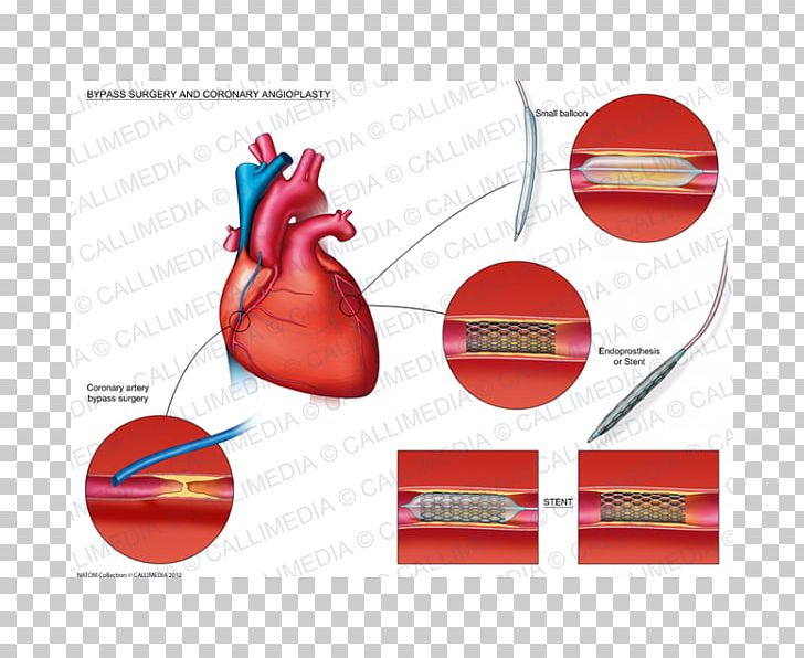 Angioplasty Heart Coronary Artery Bypass Surgery Stenting PNG, Clipart, Anatomy, Angioplasty, Brand, Cardiology, Corona Free PNG Download