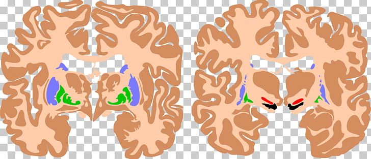 Basal Ganglia Brain Athetoid Cerebral Palsy Cerebral Cortex PNG, Clipart, Agy, Ataxic Cerebral Palsy, Basal Ganglia, Brain, Brainstem Free PNG Download