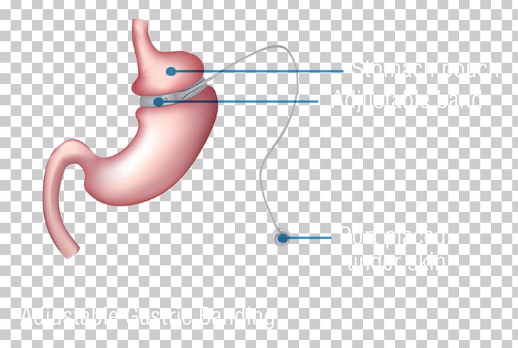 Bariatric Surgery Adjustable Gastric Band Gastric Bypass Surgery Sleeve Gastrectomy PNG, Clipart, Angle, Band, Bariatrics, Bariatric Surgery, Bypass Free PNG Download