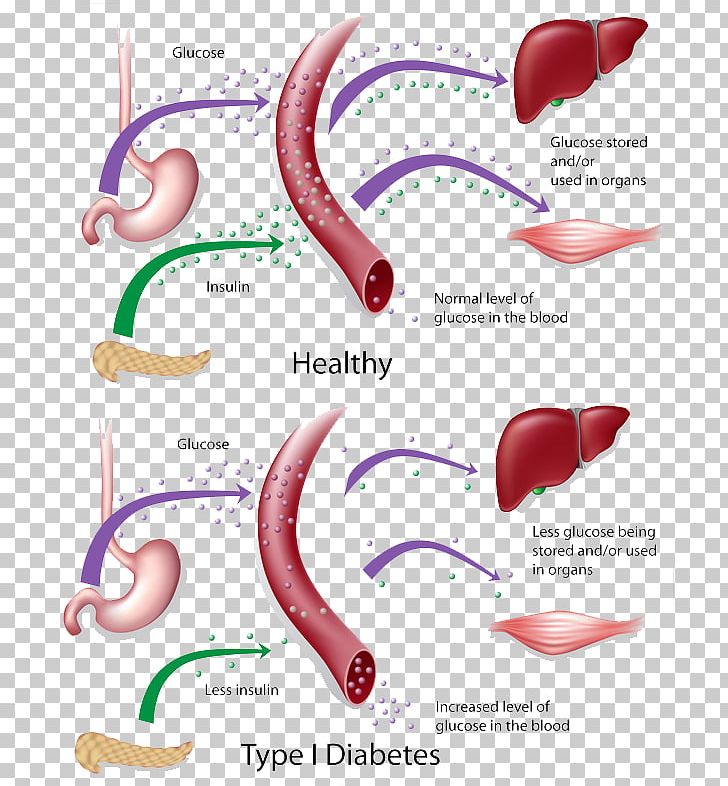 Diabetes Mellitus Type 2 Type 1 Diabetes Insulin Resistance PNG, Clipart, Blood Sugar, Diabetes Mellitus, Diabetes Mellitus Type 2, Disease, Ear Free PNG Download