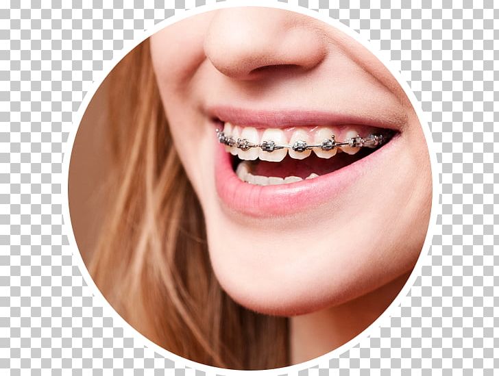 Dental Braces Dentistry Orthodontics Oral Hygiene PNG, Clipart, Cheek, Child, Chin, Clear Aligners, Closeup Free PNG Download