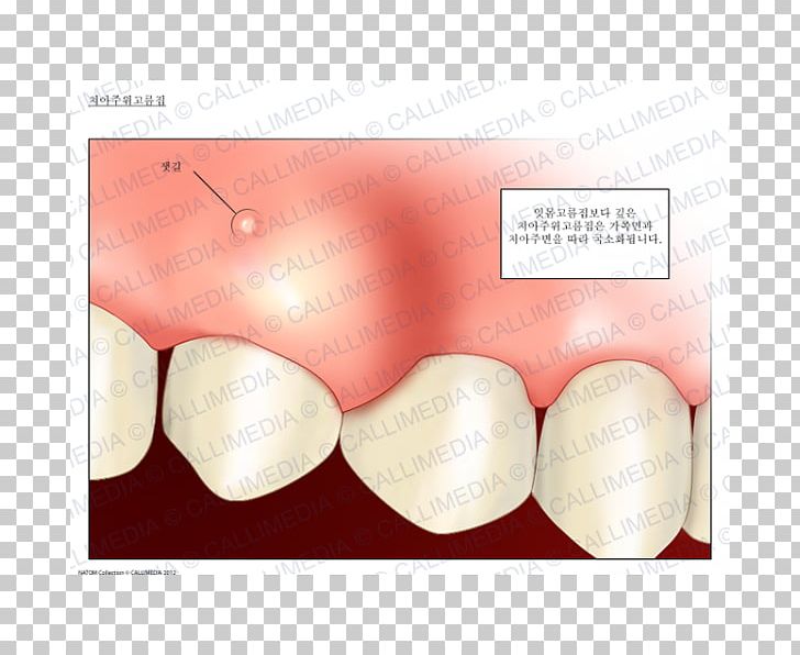 Dental Abscess Periodontal Abscess Gums Tooth PNG, Clipart, Abscess, Curettage, Cyst, Deciduous Teeth, Dental Abscess Free PNG Download