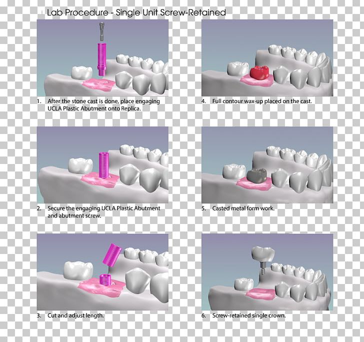 Abutment Dental Implant Dentistry PNG, Clipart, Abutment, Biomedical Engineering, Dental Implant, Dental Implants, Dentistry Free PNG Download