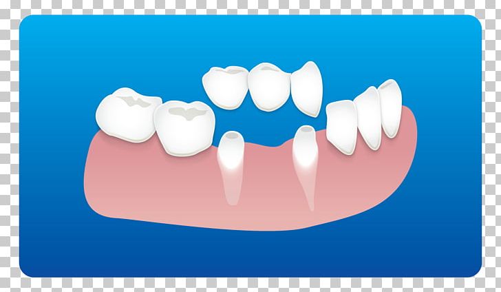 Tooth Dentistry Dental Implant Root Canal PNG, Clipart, Before And After, Cosmetic Dentistry, Dental Restoration, Dental Tourism, Dentis Free PNG Download