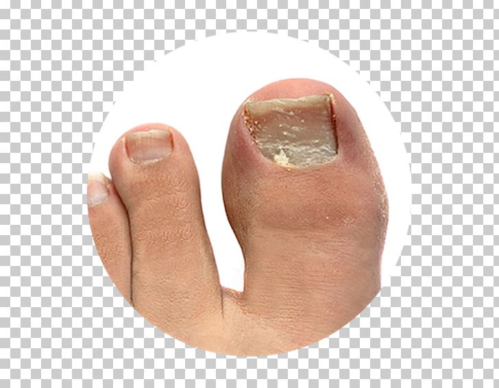 Onychomycosis Athlete's Foot Toe Nail Onychocryptosis PNG, Clipart,  Free PNG Download