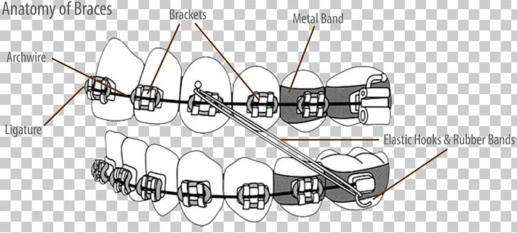 Dental Braces Molar Orthodontics Tooth Orthodontic Archwire PNG, Clipart, Alignment, Anatomy, Angle, Auto Part, Battle Of The Bands Free PNG Download