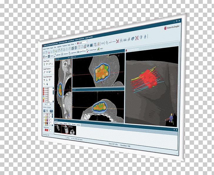 Eckert & Ziegler Display Device Brachytherapy Multimedia Radiation Treatment Planning PNG, Clipart, Advertising, Brachytherapy, Display Advertising, Display Device, Electronic Visual Display Free PNG Download