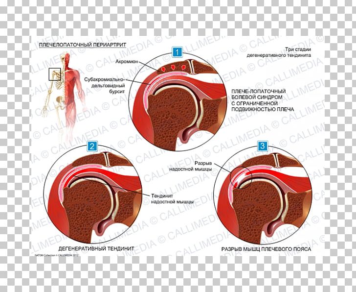 Adhesive Capsulitis Of Shoulder Periartrite Scapolo-omerale Periarthritis Rheumatology PNG, Clipart, Ache, Adhesive Capsulitis Of Shoulder, Arthritis, Calcific Tendinitis, Dislocated Shoulder Free PNG Download