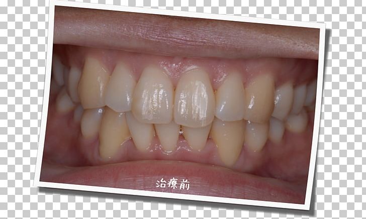 Tooth Whitening 審美歯科 Dentist Gums PNG, Clipart, Color, Cosmetic Dentistry, Dental Braces, Dentist, Dentition Free PNG Download