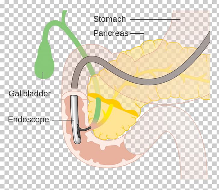 Endoscopic Retrograde Cholangiopancreatography Endoscopy Cholangiography Bile Duct Primary Sclerosing Cholangitis PNG, Clipart, Bile Duct, Cholangiography, Cholecystectomy, Common Bile Duct, Diagram Free PNG Download
