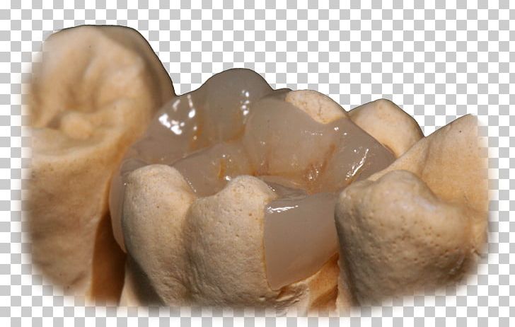 Crown CAD/CAM Dentistry Inlays And Onlays Bridge PNG, Clipart,  Free PNG Download