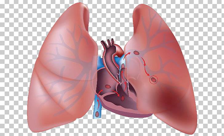 Pulmonary Embolism Thrombus Pulmonary Artery Embolus Lung PNG, Clipart, Artery, Blood, Deep Vein, Deep Vein Thrombosis, Disease Free PNG Download
