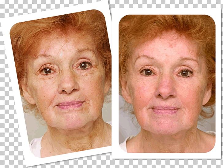 Wrinkle Anti-aging Cream Laser Surgery Skin PNG, Clipart, Acne, Ageing, Antiaging Cream, Cheek, Chin Free PNG Download