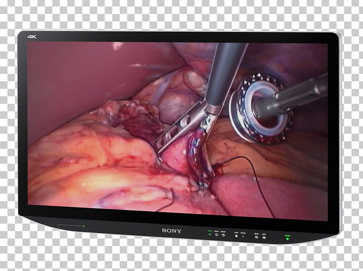 Computer Monitors Sony Corporation 4K Resolution Surgery Television PNG, Clipart, 4k Resolution, 1080p, Company, Computer Monitors, Consumer Electronics Free PNG Download