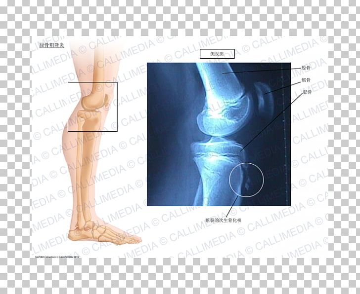 Knee Osgood–Schlatter Disease Ossification Tibia PNG, Clipart, Abdomen, Arm, Bone, Bone Disease, Disease Free PNG Download