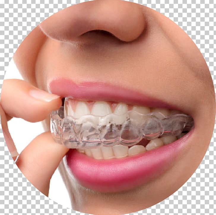 Dental Braces Clear Aligners Orthodontics Cosmetic Dentistry PNG, Clipart, Braces, Cheek, Chin, Closeup, Crown Free PNG Download