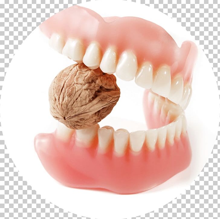 Prosthesis Tooth Bridge Dentures PNG, Clipart, Bruxism, Chin, Cracked Tooth Syndrome, Dental Implant, Dental Laboratory Free PNG Download