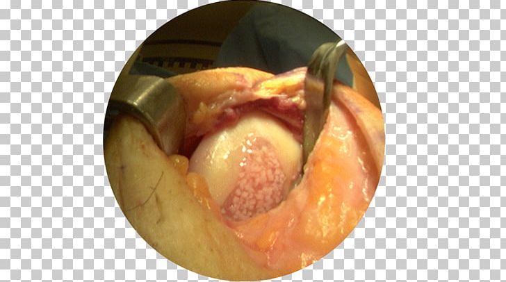 Graft Surgery Arthroscopy Knee Arthrotomy PNG, Clipart, Ankle, Arthroscopy, Arthrotomy, Articular Cartilage Repair, Cartilage Free PNG Download