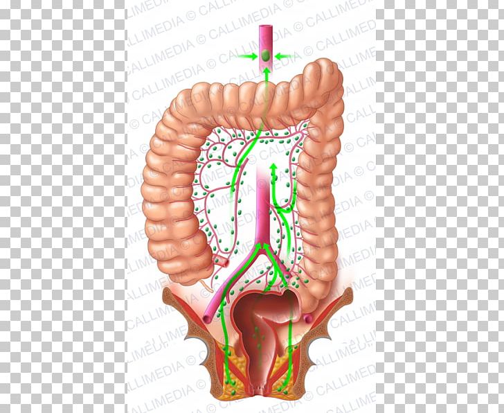 Colorectal Cancer Lymph Node Rectum PNG, Clipart, Cancer, Christmas Ornament, Colorectal Cancer, Colorectal Surgery, Cyst Free PNG Download