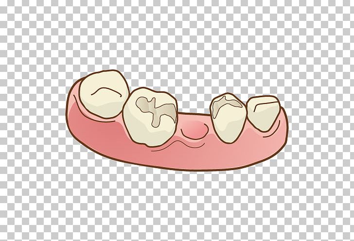 Dentist Tooth Bridge Dentures 人工歯 PNG, Clipart, Bridge, Dental Implant, Dentist, Dentistry, Dentures Free PNG Download