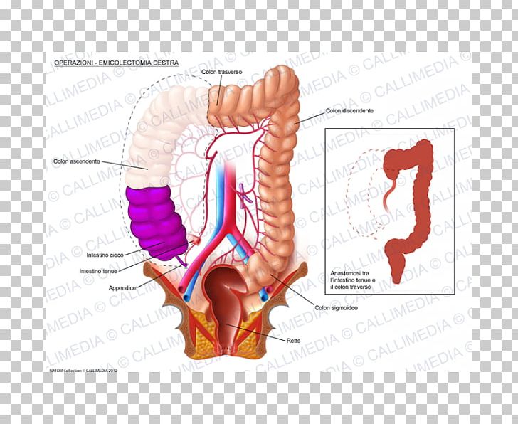 Colectomy Surgery Large Intestine Colorectal Cancer Human Digestive System PNG, Clipart, 360 Degrees, Anastomosis, Anatomy, Angle, Arm Free PNG Download